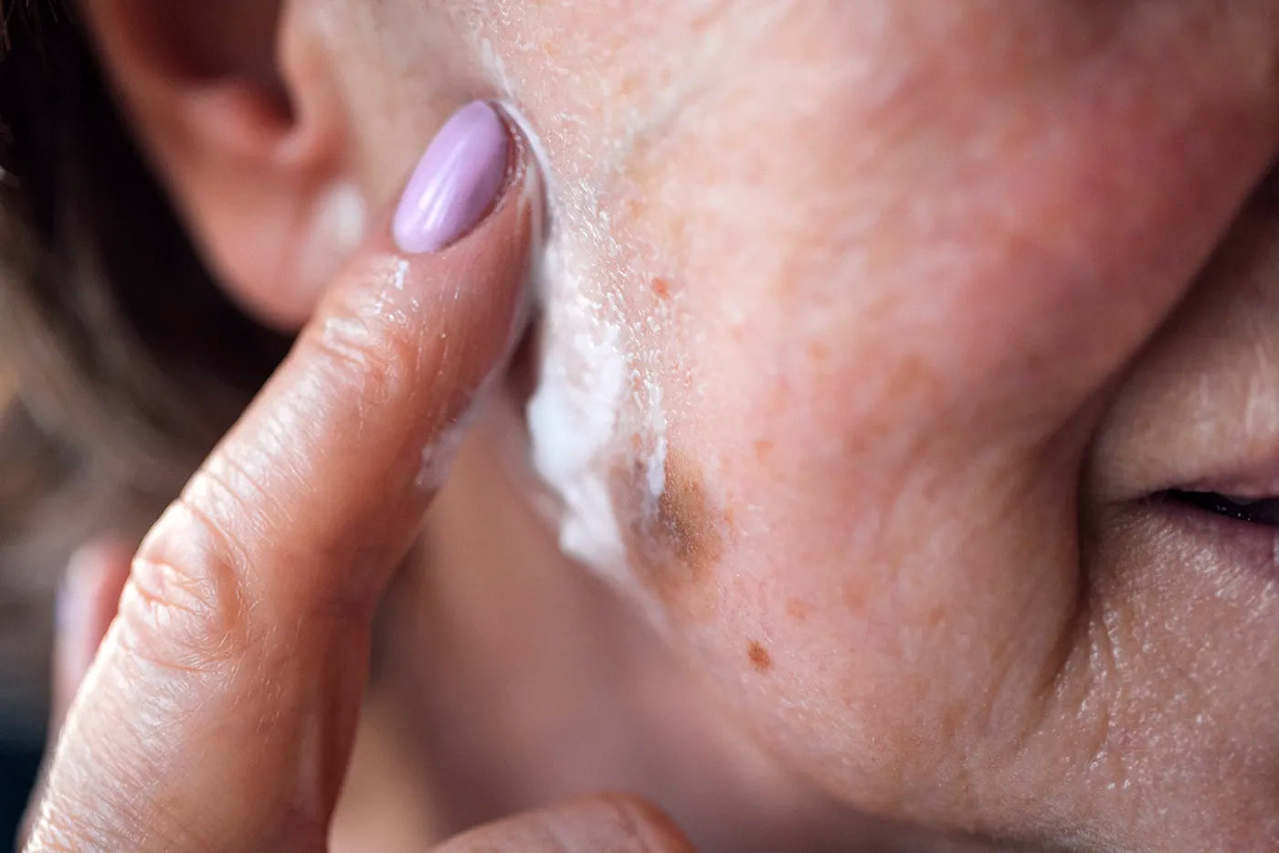 The Solution for Seborrheic Scales on Mature Skin